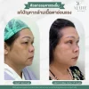ก่อนหลังผ่าตัดกล้ามเนื้อตาอ่อนแรง ALINE Clinic ก่อนหลังผ่าตัดกล้ามเนื้อตาอ่อนแรง ALINE Clinic