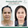 รีวิวดึงหน้า รีวิวดึงหน้า