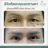  sub brow lift