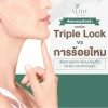 เปรียบเทียบชัด !! ศัลยกรรมดึงหน้า เทคนิค Triple Lock vs การร้อยไหม การยกกระชับแบบไหน เหมาะสมและใช่สำหรับคุณ เปรียบเทียบชัด !! ศัลยกรรมดึงหน้า เทคนิค Triple Lock vs การร้อยไหม การยกกระชับแบบไหน เหมาะสมและใช่สำหรับคุณ