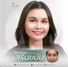 เสริมขมับ-ซิลิโคน-ราคา-รีวิว-aline-clinic เสริมขมับ-ซิลิโคน-ราคา-รีวิว-aline-clinic
