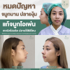 เสริมจมูกโอเพ่น เสริมจมูกโอเพ่น