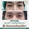 ตัดถุงใต้ตา