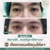 ตัดถุงใต้ตา ตัดถุงใต้ตา