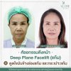 รีวิวดึงหน้า รีวิวดึงหน้า