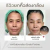 รีวิวยกคิ้วส่องกล้อง โคราช รีวิวยกคิ้วส่องกล้อง โคราช