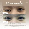 กล้ามเนื้อตาอ่อนแรง โคราช aline clinic