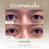รีวิวตาสองชั้น โคราช aline clinic รีวิวตาสองชั้น โคราช aline clinic