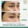 ตัดถุงใต้ตา