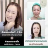ดึงหน้าโคราช