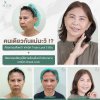 ตัดถุงใต้ตา ตัดถุงใต้ตา