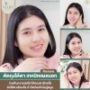 รีวิวตัดถุงใต้ตาโคราช รีวิวตัดถุงใต้ตาโคราช