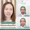 ตัดถุงใต้ตาแผลนอก