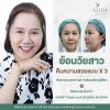 รีวิวดึงหน้า รีวิวดึงหน้า