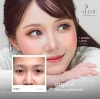 รีวิวตา 2 ชั้น โคราช aline clinic