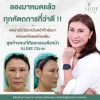 รีวิวดึงหน้า รีวิวดึงหน้า