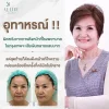 facelift facelift