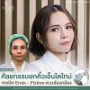 รีวิวศัลยกรรมยกคิ้วเอ็นโดไทน์ เทคนิค Endo - Fixtine แบบส่องกล้อง ที่ ALINE Clinic