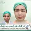 รีวิวศัลยกรรมยกคิ้วเอ็นโดไทน์ เทคนิค Endo - Fixtine แบบส่องกล้อง ที่ ALINE Clinic