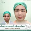 ยกคิ้วส่องกล้องเอนโดไทน์