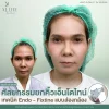 รีวิวศัลยกรรมยกคิ้วเอ็นโดไทน์ เทคนิค Endo - Fixtine แบบส่องกล้อง ที่ ALINE Clinic