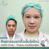 รีวิวศัลยกรรมยกคิ้วเอ็นโดไทน์ เทคนิค Endo - Fixtine แบบส่องกล้อง ที่ ALINE Clinic