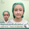 รีวิวศัลยกรรมยกคิ้วเอ็นโดไทน์ เทคนิค Endo - Fixtine แบบส่องกล้อง ที่ ALINE Clinic