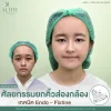 ยกคิ้วส่องกล้อง endotine