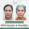 รีวิวดึงหน้าโคราช