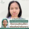 ตัดถุงใต้ตาพร้อมดึงหน้าส่วนกลาง ตัดถุงใต้ตาพร้อมดึงหน้าส่วนกลาง