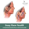 ดึงหน้า deep plane facelift