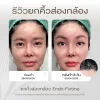 รีวิวภาพก่อนและหลังทำศัลยกรรมยกคิ้วส่องกล้องเทคนิค Endo-Fixtine ที่ ALINE Clinic แสดงผลลัพธ์หลังทำ 8 วัน ดวงตาดูสดใส คิ้วได้รูปสวยงาม และแผลผ่าตัดขนาดเล็กซ่อนในไรผม