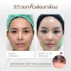 รีวิวยกคิ้วส่องกล้อง โคราช รีวิวยกคิ้วส่องกล้อง โคราช