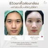 รีวิวยกคิ้วส่องกล้อง ตาสองชั้น ตัดถุงใต้ตา โคราช aline clinic รีวิวยกคิ้วส่องกล้อง ตาสองชั้น ตัดถุงใต้ตา โคราช aline clinic