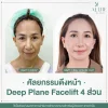 รีวิวดึงหน้า รีวิวดึงหน้า