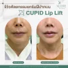 รีวิวศัลยกรรมยกริมฝีปากบน CUPID Lip lift