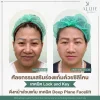 รีวิวศัลยกรรมเสริมร่องแก้ม aline clinic