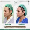 รีวิวศัลยกรรมเลื่อนไรผม ลดขนาดหน้าผาก