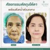 ตัดถุงใต้ตา