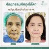 ตัดถุงใต้ตา ตัดถุงใต้ตา