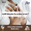 การให้ lidocaine ใน cardiac arrest ?