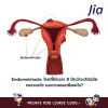 Endometriosis: โรคที่ใช้เวลา 8 ปีกว่าจะวินิจฉัย เพราะอะไร และทางออกคืออะไร?