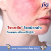 วิจัยไทย-จีนค้นพบความลับโรค "โรซาเซีย" (Rosacea) หน้าแดงง่าย ผื่นเรื้อรัง รักษาได้ตรงจุดมากขึ้น! วิจัยไทย-จีนค้นพบความลับโรค "โรซาเซีย" (Rosacea) หน้าแดงง่าย ผื่นเรื้อรัง รักษาได้ตรงจุดมากขึ้น!
