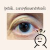 รู้หรือไม่ วงขาวๆที่ขอบตาดำคืออะไร ? รู้หรือไม่ วงขาวๆที่ขอบตาดำคืออะไร ?