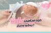 Cradle Cap ผื่นไขบนหัวทารก อันตรายไหม?