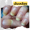 เมื่อเล็บเหลือง แก้ปัญหาอย่างไร  เมื่อเล็บเหลือง แก้ปัญหาอย่างไร