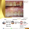 โปรโมชั่นวีเนียร์