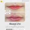 ฟิลเลอร์ปาก