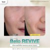 ฟิลเลอร์งานผิว (Revive)