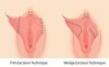 labiaplasty ผ่าตัดเลเบีย ตกแต่งเลเบีย labiaplasty ผ่าตัดเลเบีย ตกแต่งเลเบีย